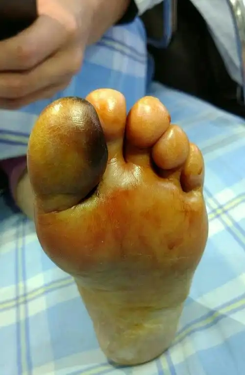 62岁女性,短短一个月,脚趾发黑,溃烂,剧烈疼痛,寝食难安.
