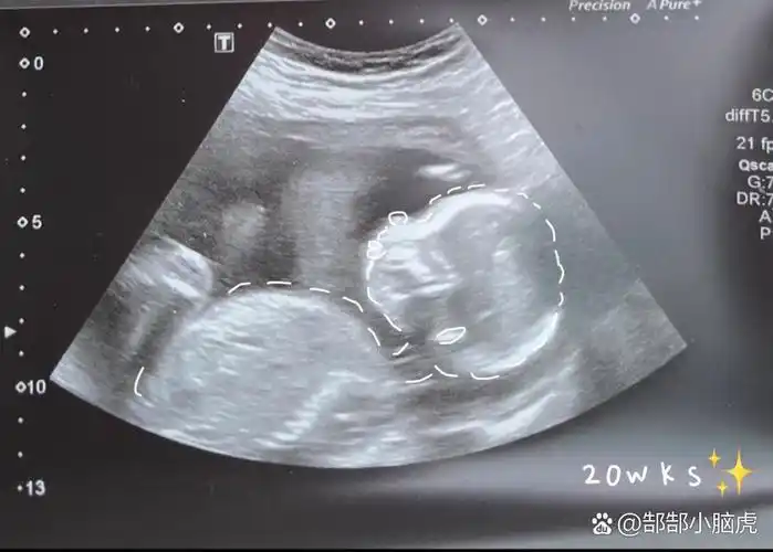 001 20周的宝宝b超图怎么这么圆