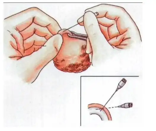 彻底,只要结扎后把残留的精子排光,就不会生育了,而且并不是永远绝育