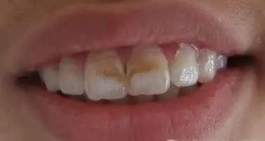 首页 > 烟渍牙      烟渍牙不仅影响牙齿美观,严重时还会伴随有口臭等