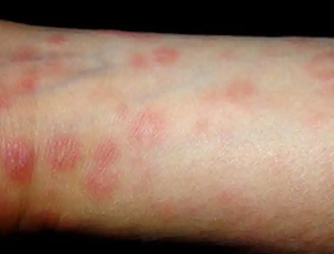 一期梅毒初期生殖器图片