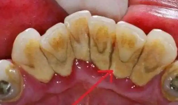 满嘴牙结石又臭又硬牙医学会2个小妙招口臭牙垢不见了