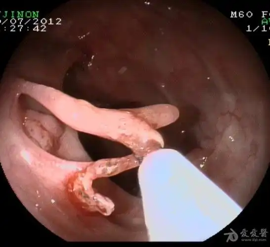 结肠桥接状息肉