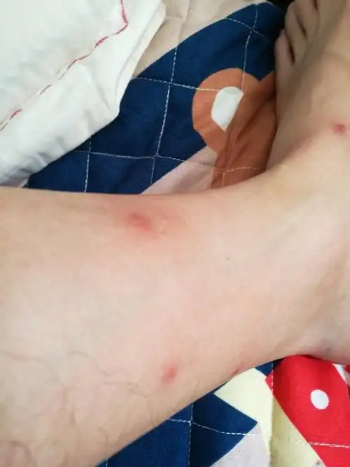 身上多处被蚊子叮咬,一大片红红的疙瘩,很痒很难受,怎么样才能止痒,才