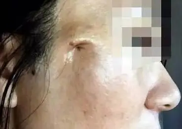 线雕手术后脸会坑洼不平吗