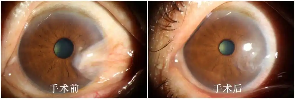 眼睛长胬肉不要愁显微镜手术解您忧