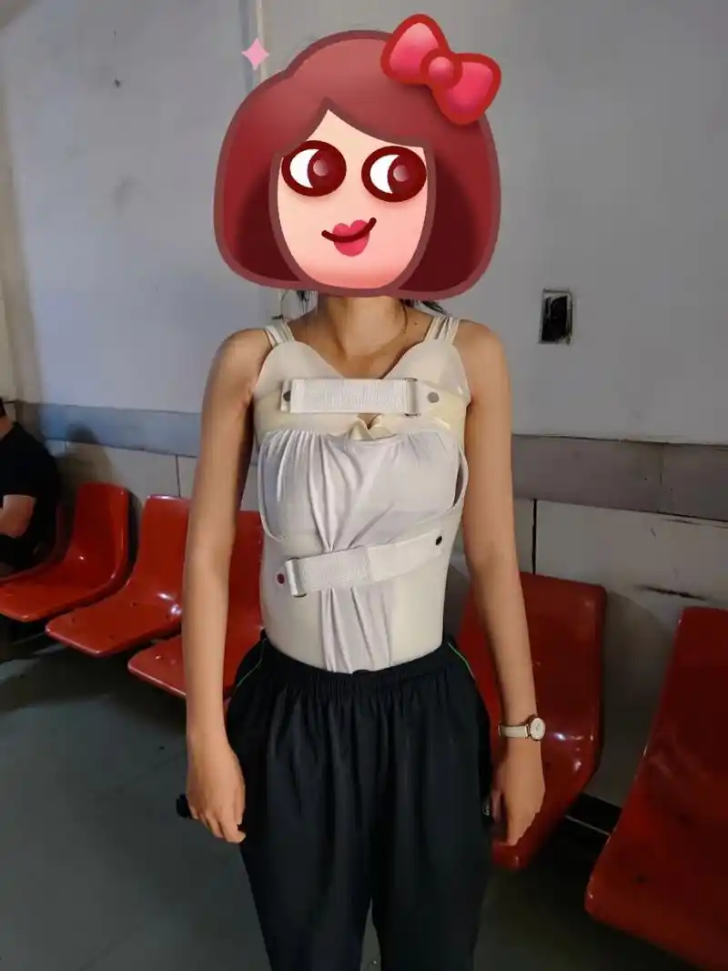 脊柱侧弯# #脊柱侧弯支具#  矫正,佩戴四小时后效果惊呆了!