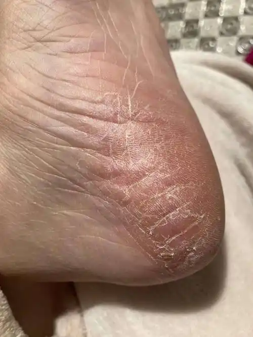 原创脚后跟干裂起硬皮这是足癣还是和身体有关