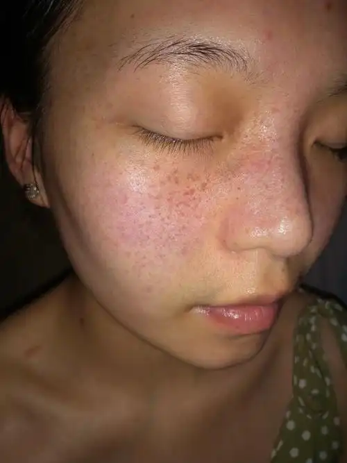 进口祛斑霜美白淡化色斑去斑祛黄褐斑雀斑产品神器官方旗舰店正品