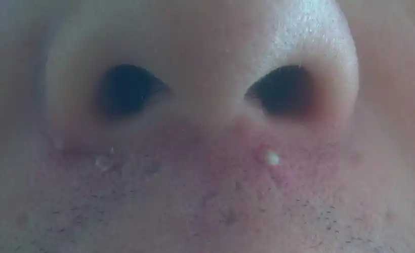 我鼻子下边的皮肤是什么病?