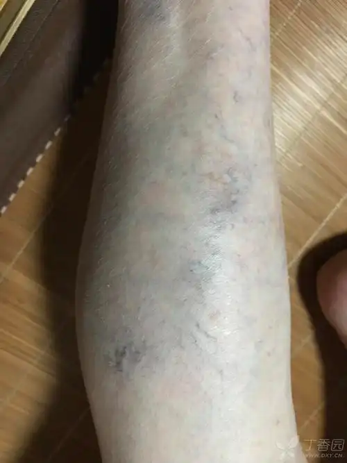 小腿瘀斑血管明显,考虑什么?