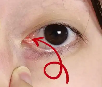 眼角内长了个小白脓点图片