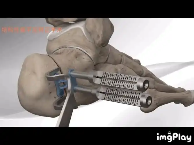 如何有效矫正扁平足