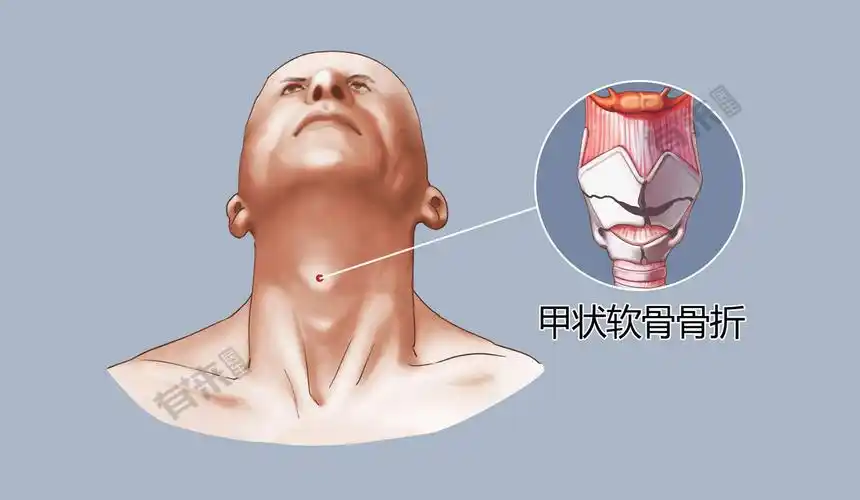 男性甲状软骨前缘的角度较小,为直角或锐角,上端向前突出,形成喉结,是