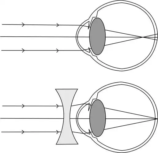 孩子近视了 靠激光手术就能解决问题吗?