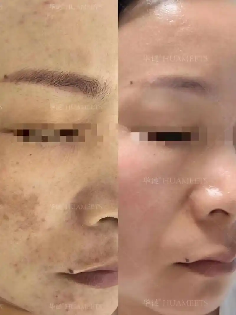 祛斑反馈:黄褐斑 真皮斑 痘印.在这个吃饭都要看菜品颜值的时 - 抖音