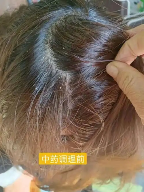 头皮屑异常增多的原因  #怎么治疗头皮屑  #头皮屑太多或导致脱发