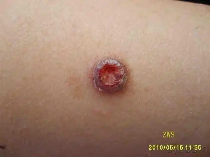 通过病理诊断的纤维瘤 - 皮肤及性传播疾病讨论版 - 爱爱医医学论坛