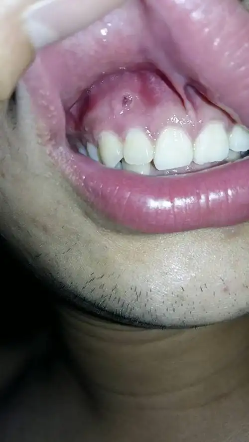 上方虎牙牙龈流脓,已经很长时间了,如果有时候里面的脓流不出来就会