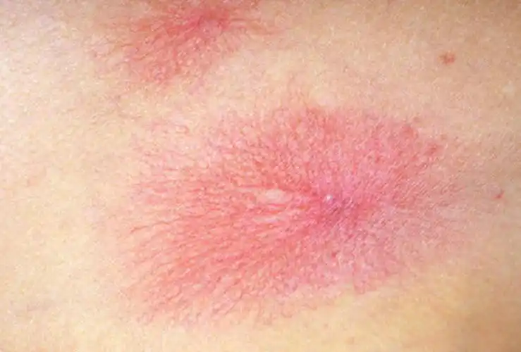 看到血痣,得了肝癌无疑?真正与肝病有关的红痣,是它