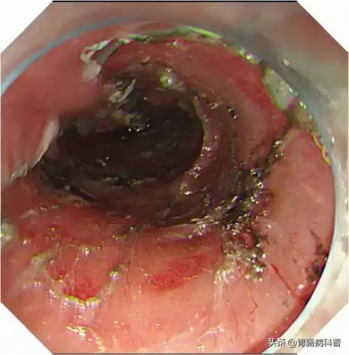 食管癌发病率高,男性多于女性
