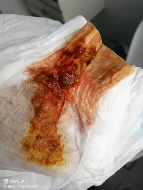 婴儿便血,有图慎入 - 百度宝宝知道