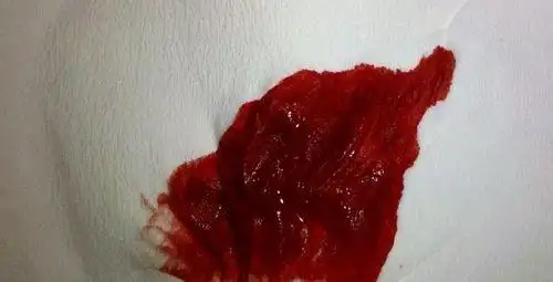 突然便血怎么回事