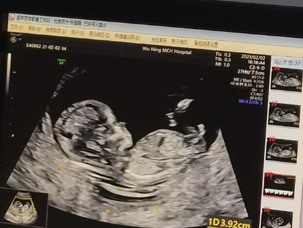 孕12周查nt看男宝特点的是什么