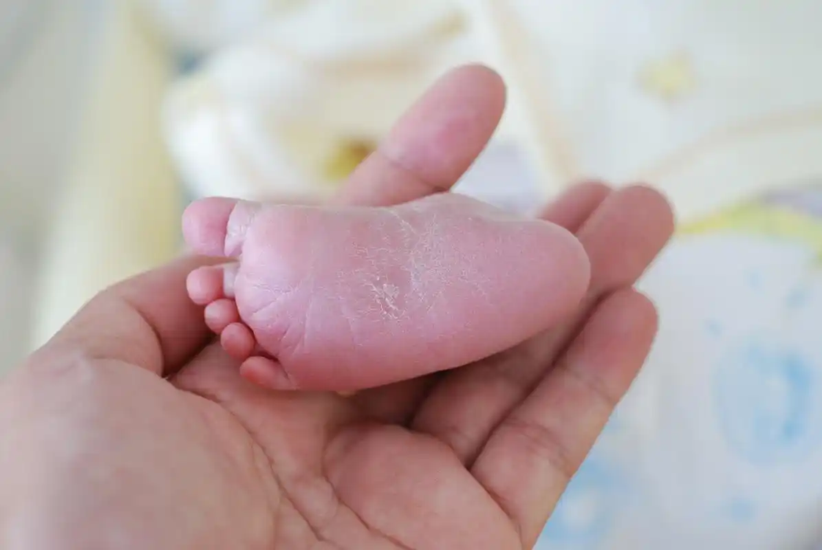 家里洗小孩的衣服要单独洗,不要让小孩穿有脚气的大人的鞋子,让大人