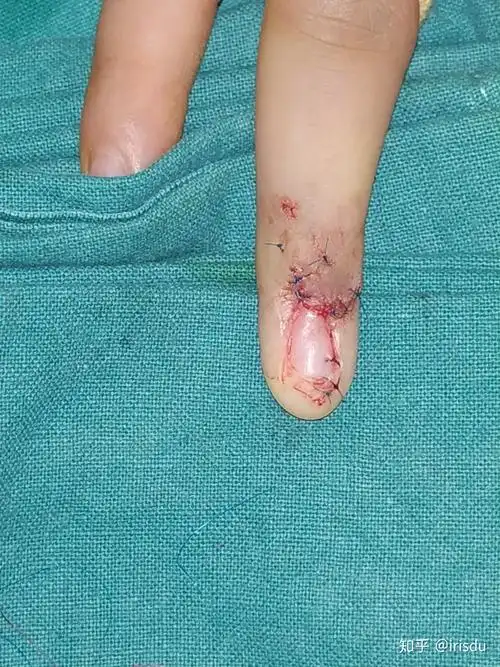 如图对于全甲甲母痣或怀疑恶性的通常采取完全切除,术后没有指甲;如果