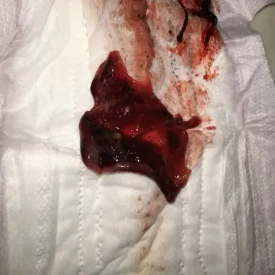 怀孕初期流血肚子疼流出这个东西,是不是孩子没了?