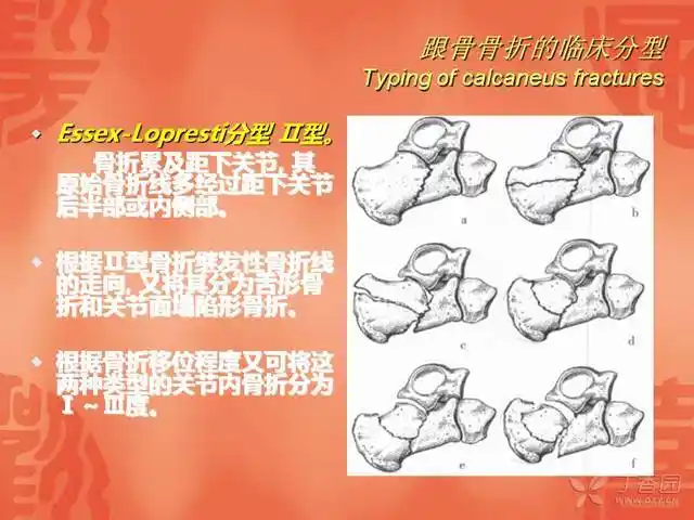 跟骨骨折的分型与治疗