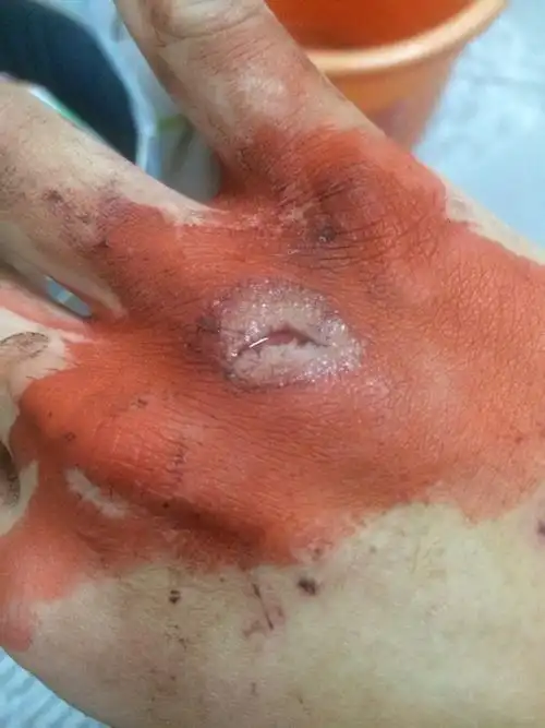 昨晚被玻璃划伤,怎么处理? 简单擦了红药水,消毒