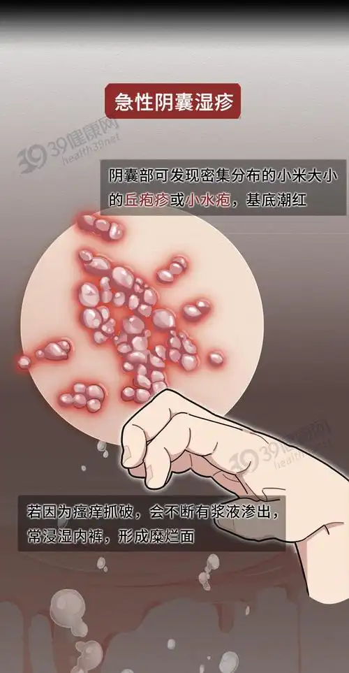 急性期,亚急性期和慢性期阴囊湿疹可以分为三期按皮肤损害的表现67