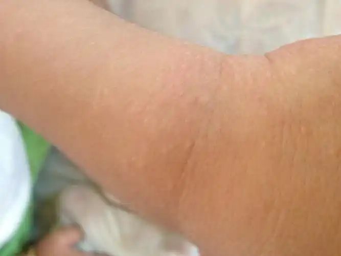 两周岁半孩子 一只手上起白点