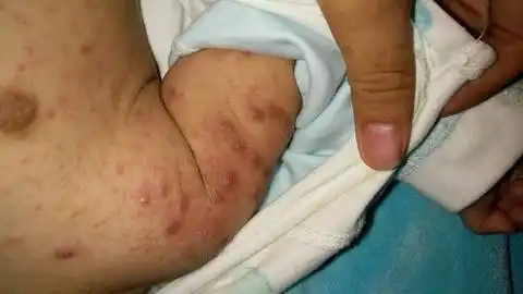 宝宝疥疮全身怎麼办