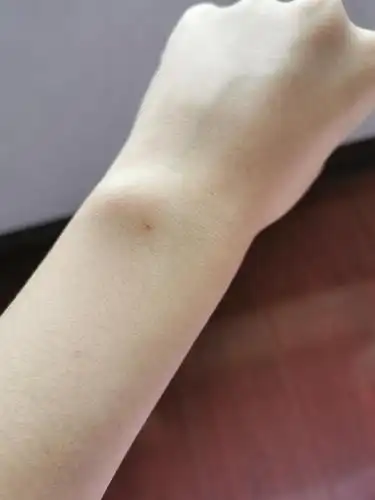 姐妹们有长过红色的痣的吗?这个要点吗?