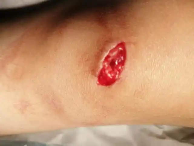 西安9岁女孩学游泳时磕破膝盖 游泳馆称:不会逃避应负责任