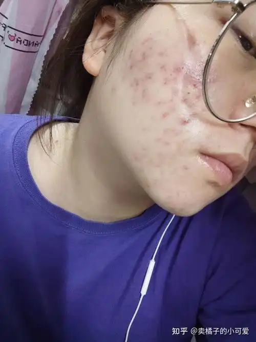 三阶段(全脸爆痘)