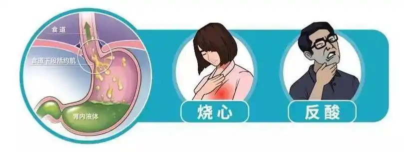 我们知道,胃食管反流病的典型症状就是反酸,烧心,也可以出现胸骨后