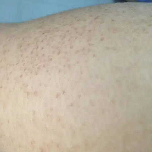 手臂上上有一点一点黑黑的是什么