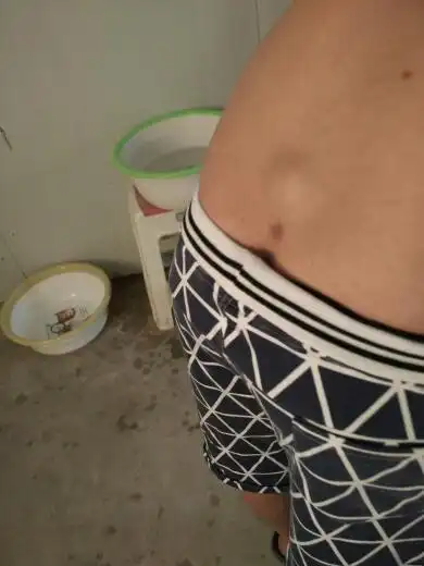 腰后面,屁股上面鼓起来一个包.不疼不痒,什么什么啊