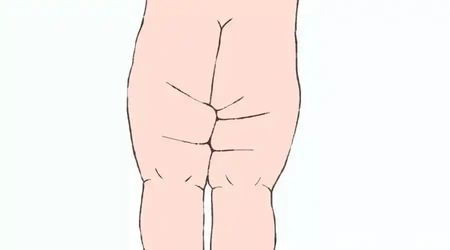 3个月的宝宝腿纹不对称是髋关节发育不良吗?