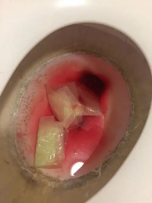 大便时出了很多血是为什么!