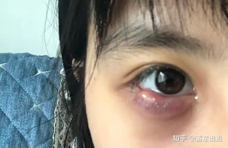 记录麦粒肿(撅眼) - 知乎