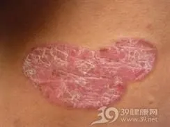 「外阴银屑病」外阴银屑病的症状-治疗-病因-好评专家-疾病查询-39