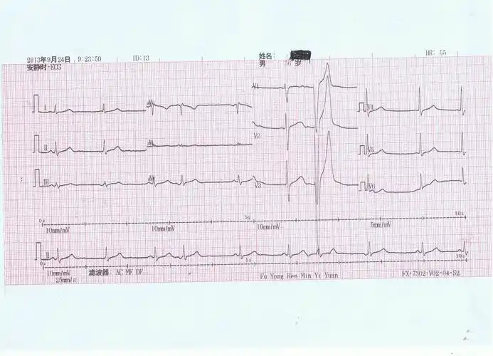 交界性早搏伴部分未下传,交界性逸搏 - 心电图脑电图专业讨论版