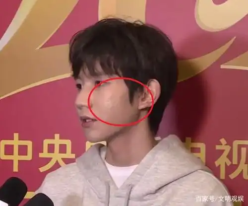王源再次接受央视采访,在"照妖镜"之下,面部上痘痘很明显!