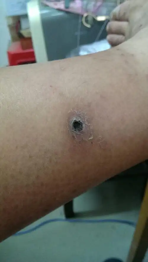 小腿上有个黑色凹陷的结痂,2个多月了