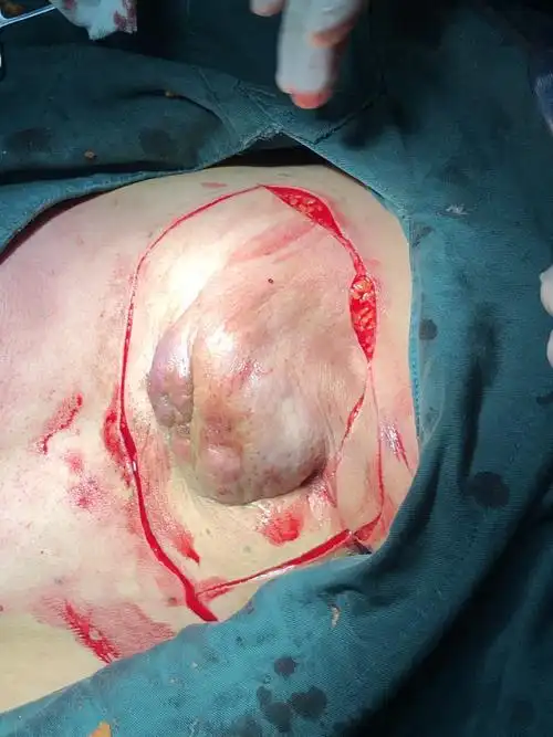 乳腺外科—背阔肌带蒂皮瓣转移修复乳腺癌伴腋窝肿瘤切除术后巨大创面